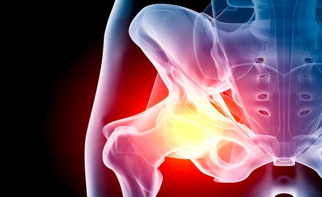 arthrosis ti ibadi isẹpo