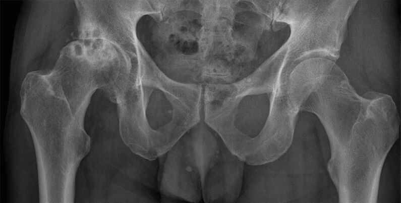 Idibajẹ arthrosis ti isẹpo ibadi lori x-ray