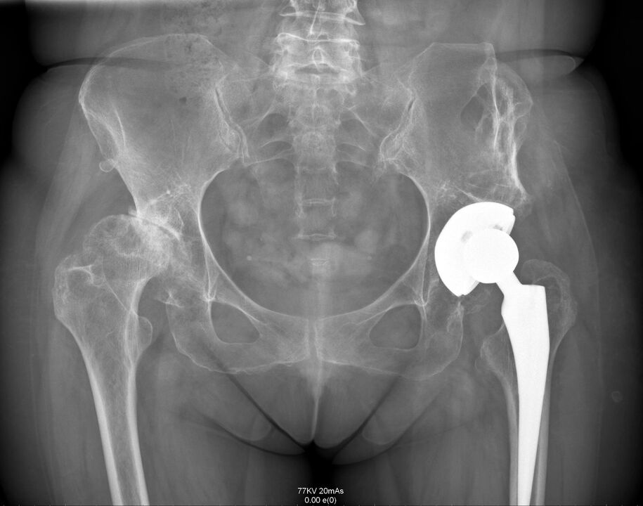 X-ray ti isẹpo ibadi lẹhin arthroplasty