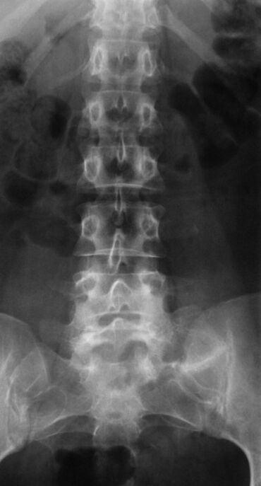 Lati ṣe iwadii osteochondrosis lumbar, a ṣe radiography