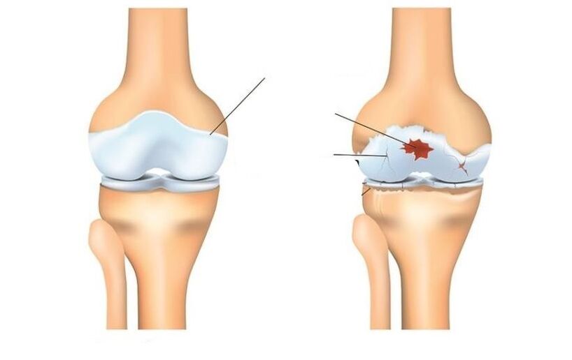 Ni ilera ati alaisan pẹlu awọn isẹpo arthrosis