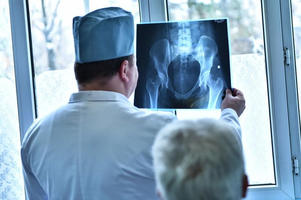 Dọkita naa wo aworan kan ti isẹpo ibadi pẹlu arthrosis