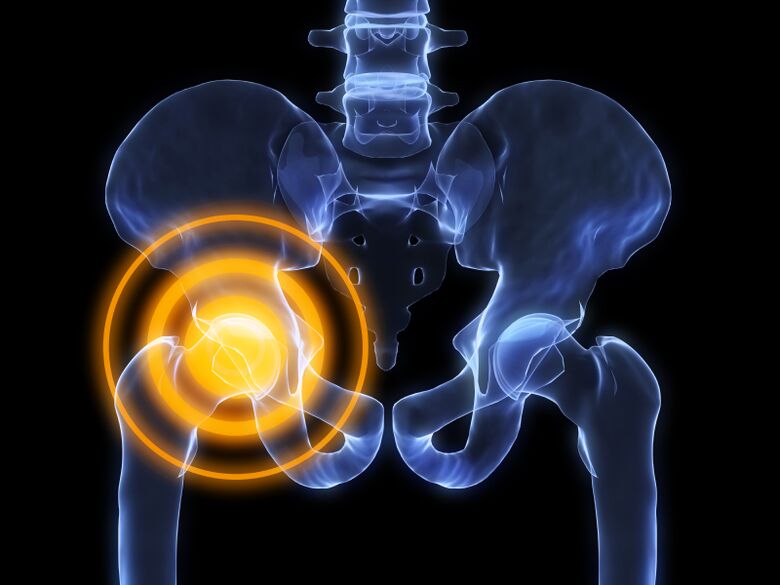 arthrosis ti ibadi isẹpo