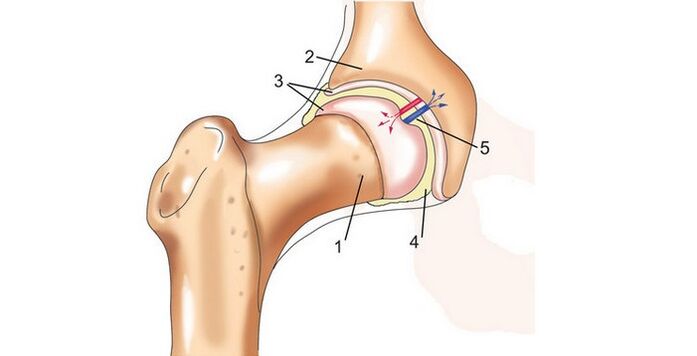 ibadi isẹpo ati arthrosis